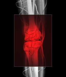 arthritis joint pain