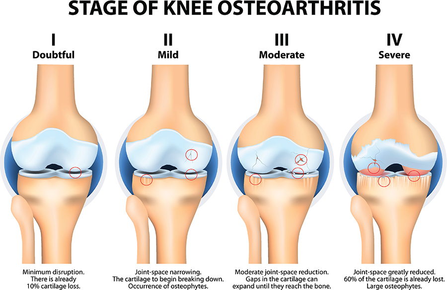 The Four Phases of Osteoarthritis in Knees