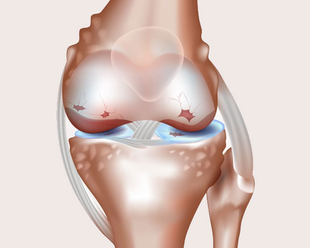 Glucosamine Benefits in Rehabilitation of Cartilage